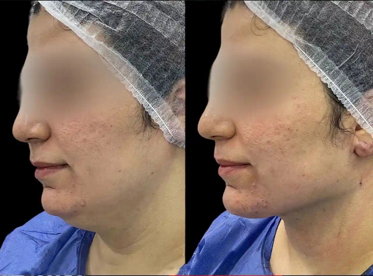 Where to Find the Best Aesthetic Clinics in dubai for Chin Fillers