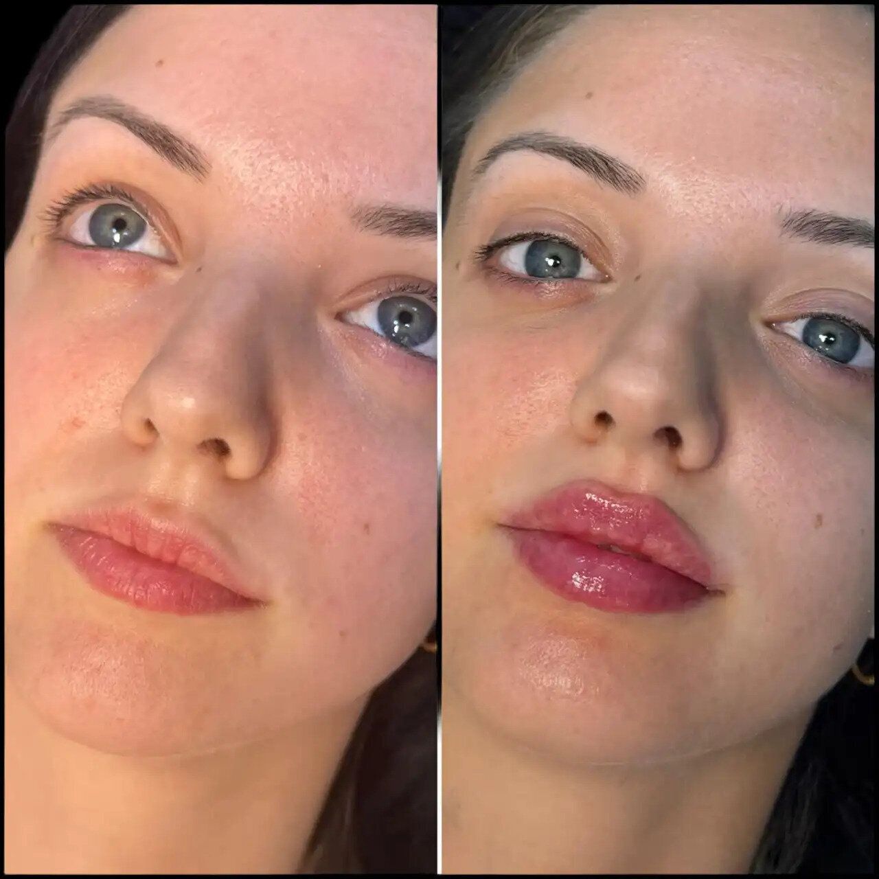 Mistakes to Avoid When Choosing the Best Doctors in Dubai for Fillers