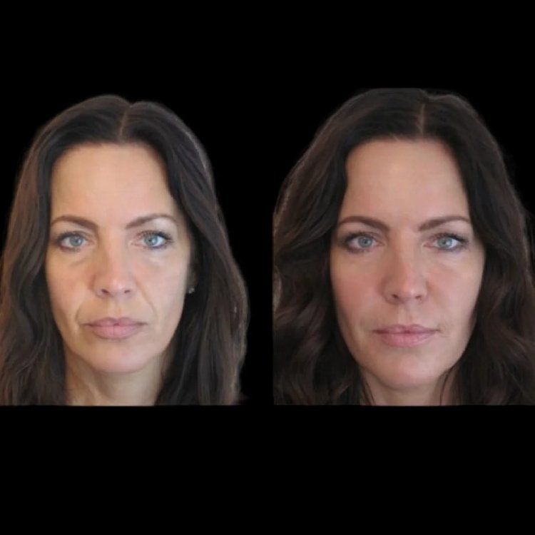 Jawline Fillers in Dubai: A Detailed Look at the Treatment Process