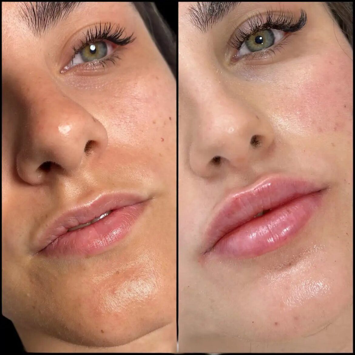Best Plastic Surgeon in Dubai for Fillers and Smooth Facial Rejuvenation